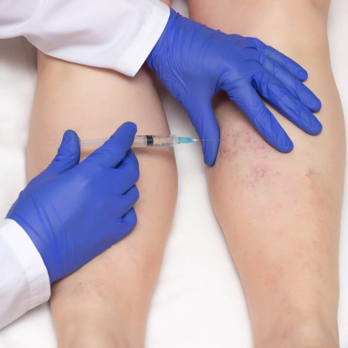Vein Sclerotherapy By Enchanted Medical Aesthetics