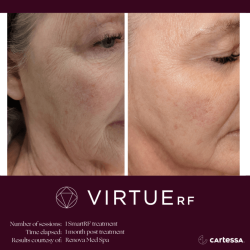 Virtue RF Microneedling Before and After By Enchanted Medical Aesthetics