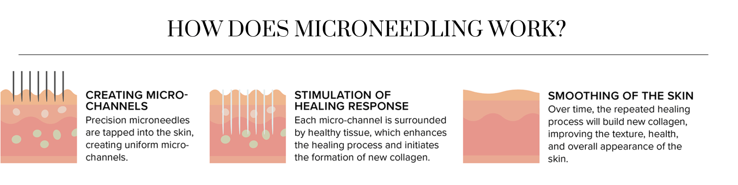 How Does Microneedling Work By Enchanted Medical Aesthetics