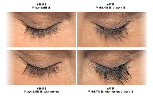 Latisse Eye Treatment Before and After By Enchanted Medical Aesthetics