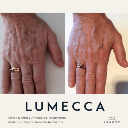 Hand Lumecca IPL Treatment Before and After By Enchanted Medical Aesthetics