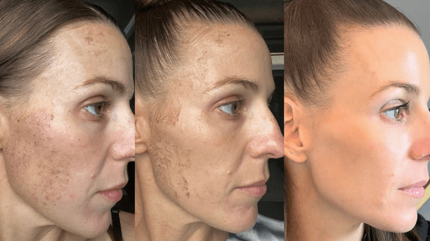 New Moon Makeover Before and After By Enchanted Medical Aesthetics