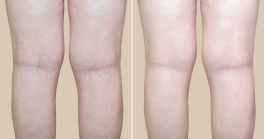 Sclerotherapy Legs Before and After Treatment By Enchanted Medical Aesthetics