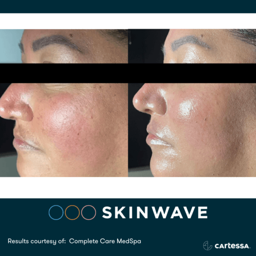 Skinwave Before And After By Enchanted Medical Aesthetics