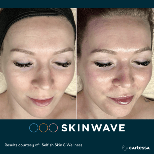 Skinwave Before And After By Enchanted Medical Aesthetics