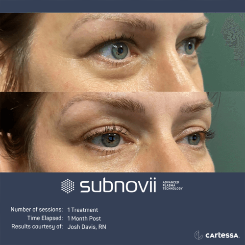 Female Subnovii Plasma Pen Before and After By Enchanted Medical Aesthetics