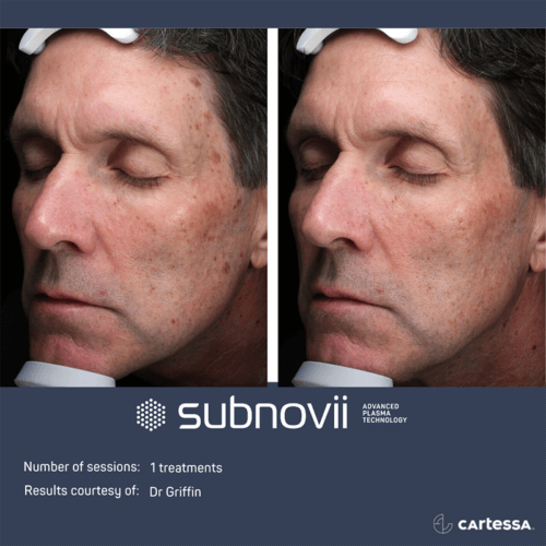 Male Subnovii Plasma Pen Before and After By Enchanted Medical Aesthetics