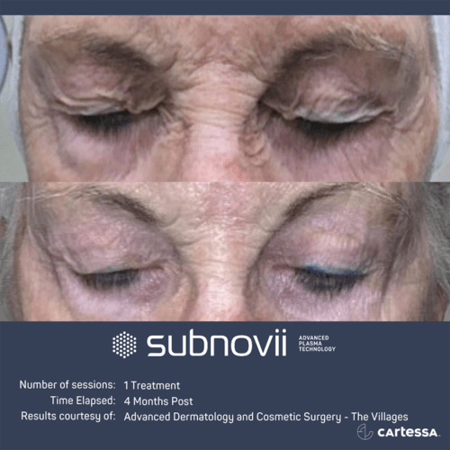 Subnovii Plasma Pen Before and After By Enchanted Medical Aesthetics