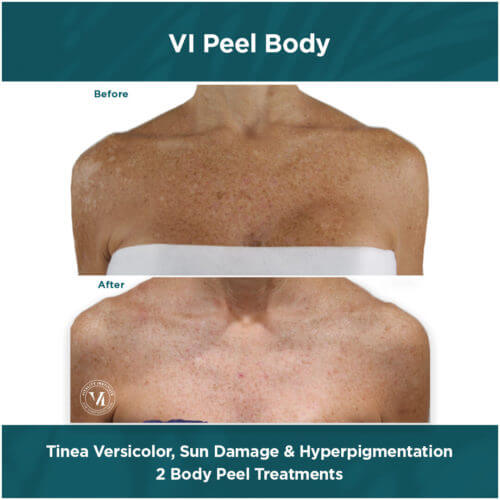 VI Peel Body Before and After By Enchanted Medical Aesthetics