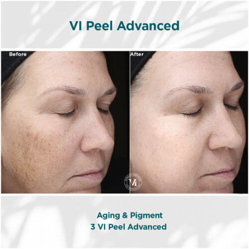 VI Peel Advanced Before and After By Enchanted Medical Aesthetics