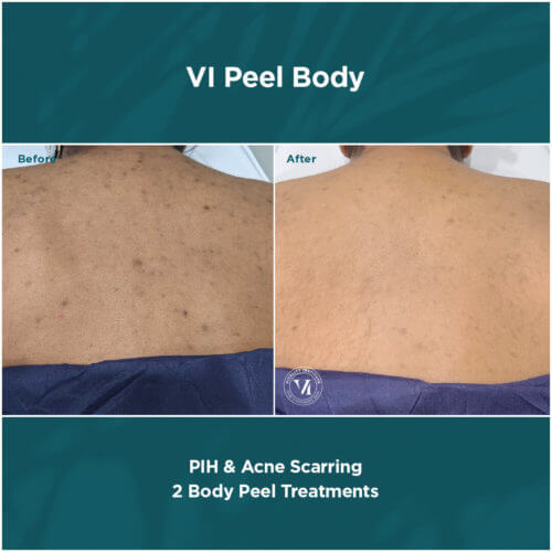 VI Peel Body Before and After By Enchanted Medical Aesthetics