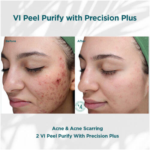 VI Peel Purify with Precision Plus Before and After By Enchanted Medical Aesthetics
