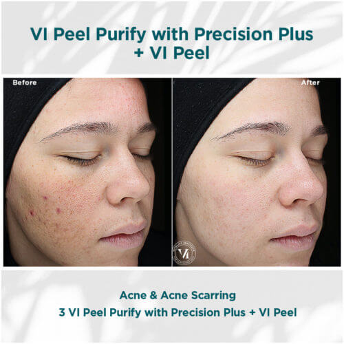 VI Peel Purify with Precision Plus + VI Peel Before and After By Enchanted Medical Aesthetics