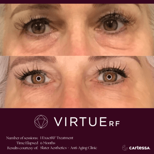 Eyes Virtue RF Microneedling Before and After By Enchanted Medical Aesthetics