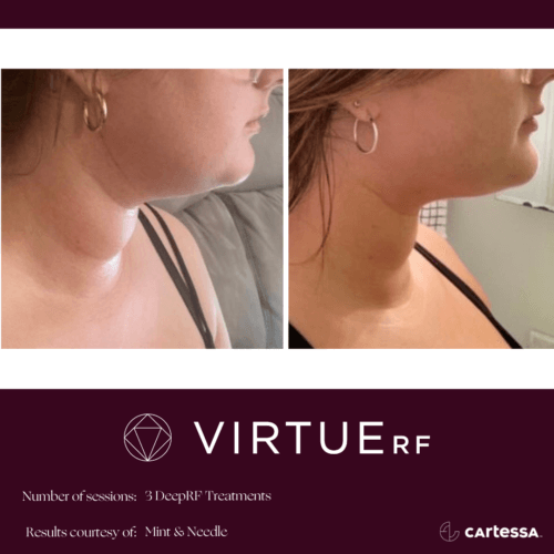 Neck Virtue RF Microneedling Before and After By Enchanted Medical Aesthetics