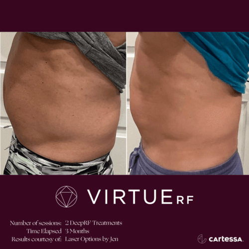 Stomach Virtue RF Microneedling Before and After By Enchanted Medical Aesthetics