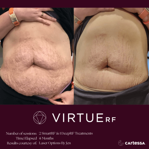 Stomach Virtue RF Microneedling Before and After By Enchanted Medical Aesthetics
