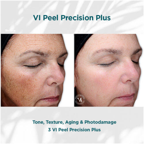 VI Peel Precision Plus Before and After By Enchanted Medical Aesthetics