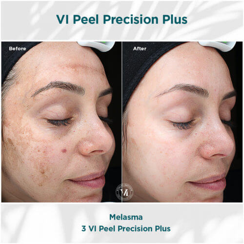 VI Peel Precision Plus Before and After By Enchanted Medical Aesthetics