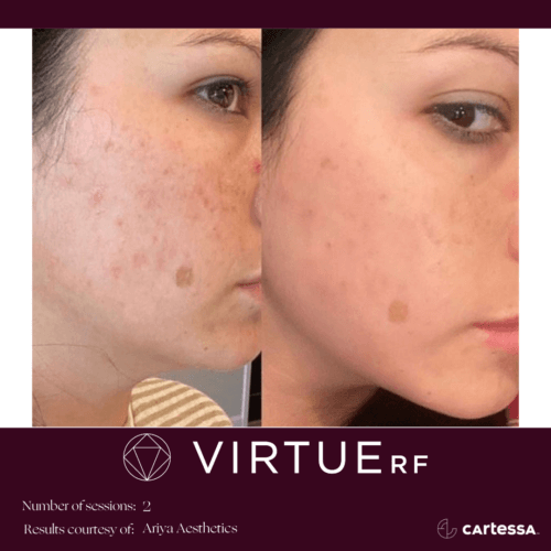 Virtue RF Microneedling Before and After By Enchanted Medical Aesthetics