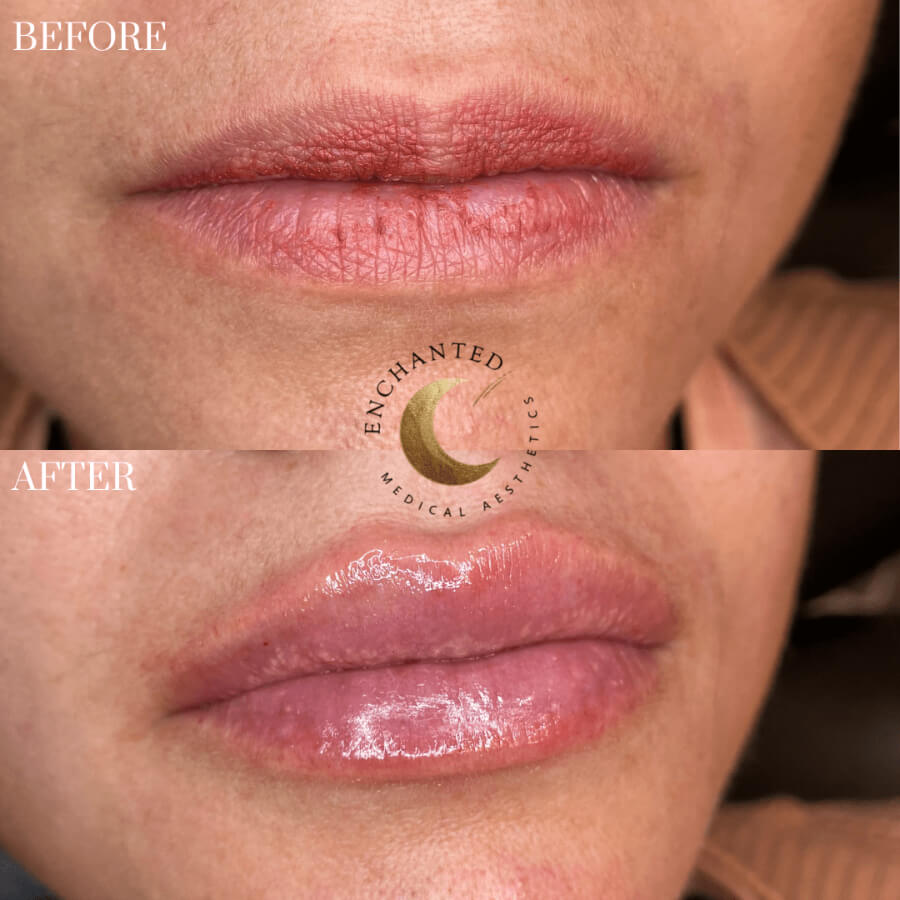 Lip Filler Before and After Photos By Enchanted Medical Aesthetics