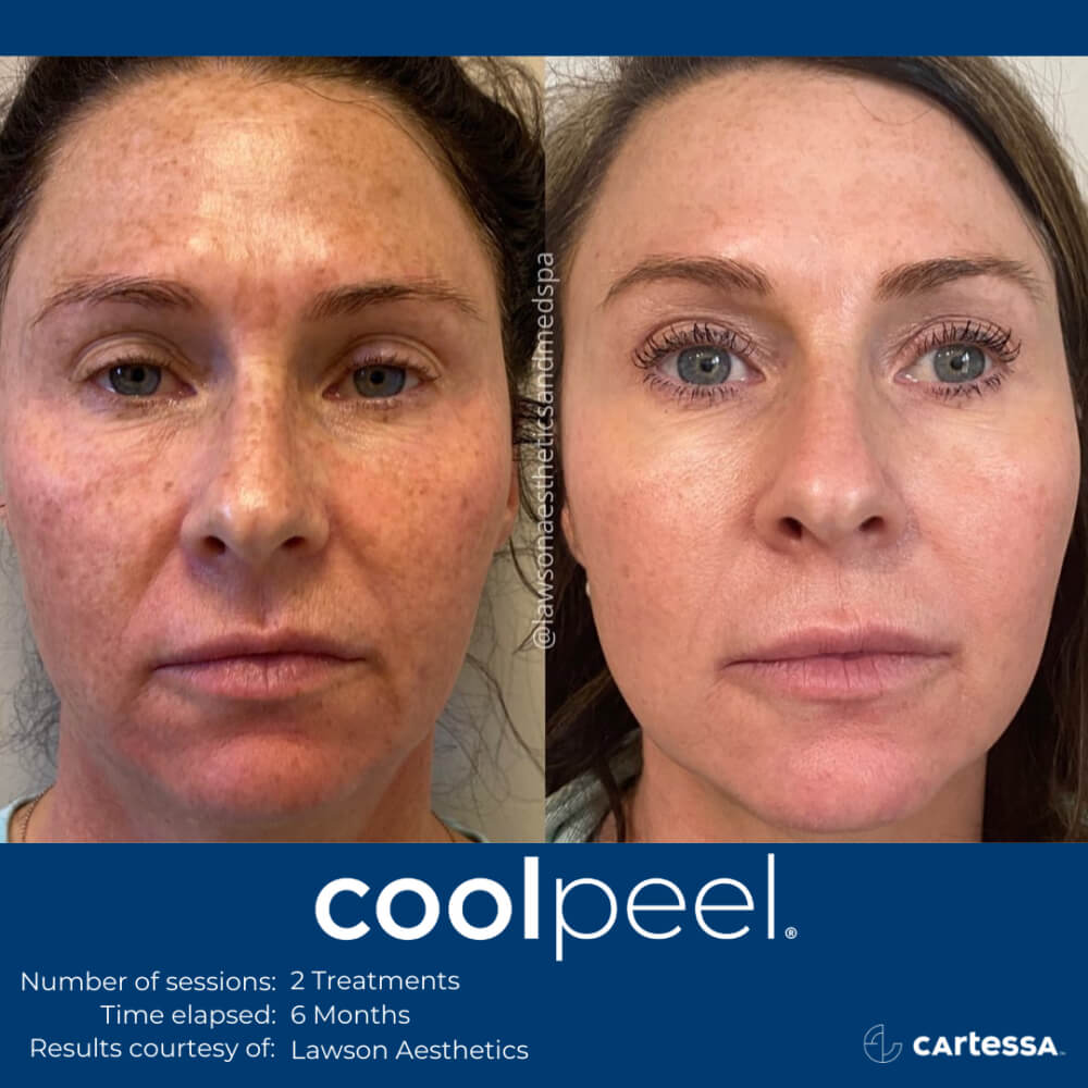 Tetra CoolPeel and CO2 Treatments