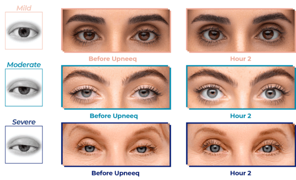 Upneeq Eyes Before and After Treatment By Enchanted Medical Aesthetics