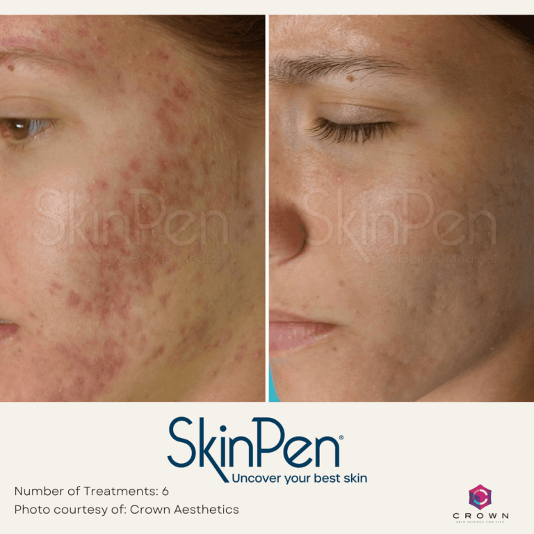 Microneedling with PRP Before and After By Enchanted Medical Aesthetics