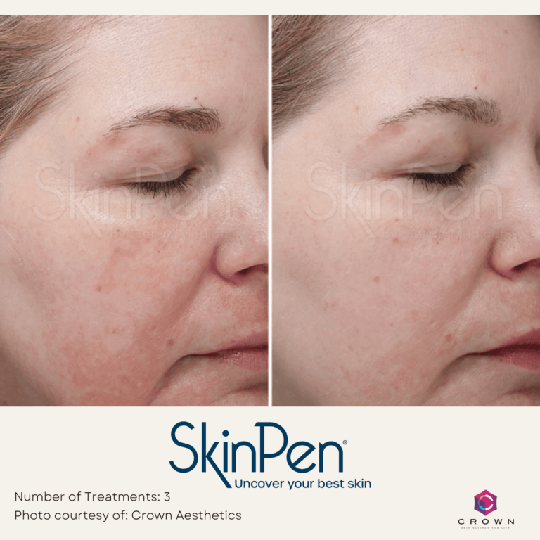 Microneedling with PRP Before and After By Enchanted Medical Aesthetics