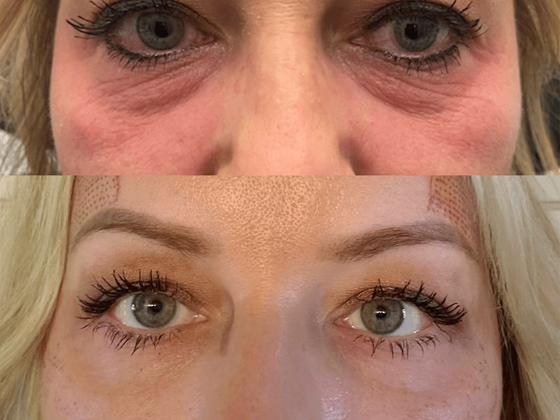 Subnovii Plasma Pen Treatment Before and After By Enchanted Medical Aesthetics