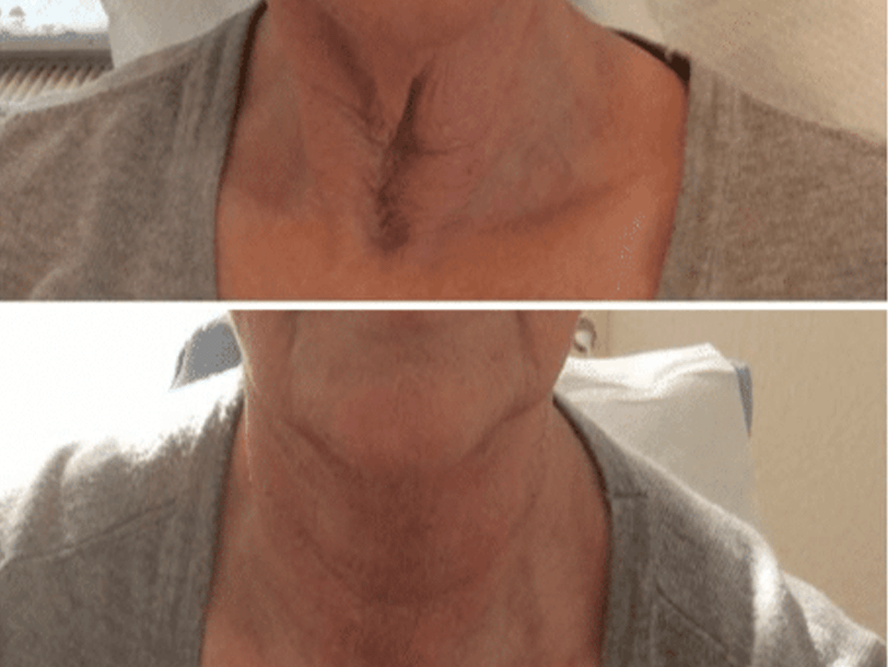 Subnovii Plasma Pen Treatment Before and After By Enchanted Medical Aesthetics