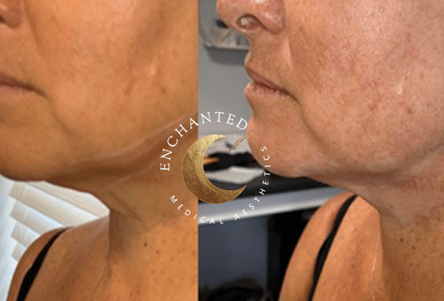 Thread lift Treatment Before and After By Enchanted Medical Aesthetics
