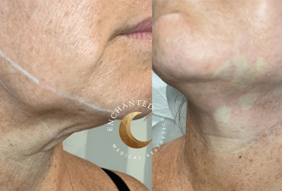 Thread lift Treatment Before and After By Enchanted Medical Aesthetics