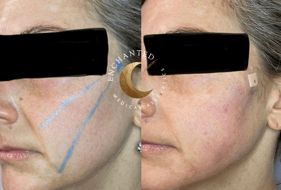 Threadlift Treatment Before and After By Enchanted Medical Aesthetics