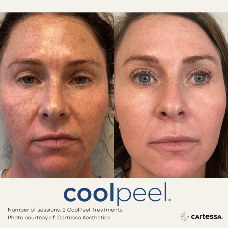 Coolpeel Treatment Before and After By Enchanted Medical Aesthetics