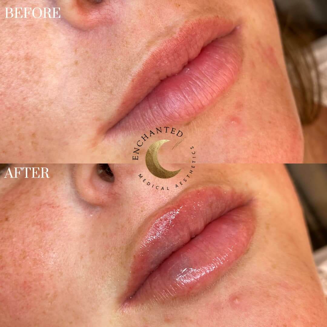 Lip Filler Treatment Before and After By Enchanted Medical Aesthetics