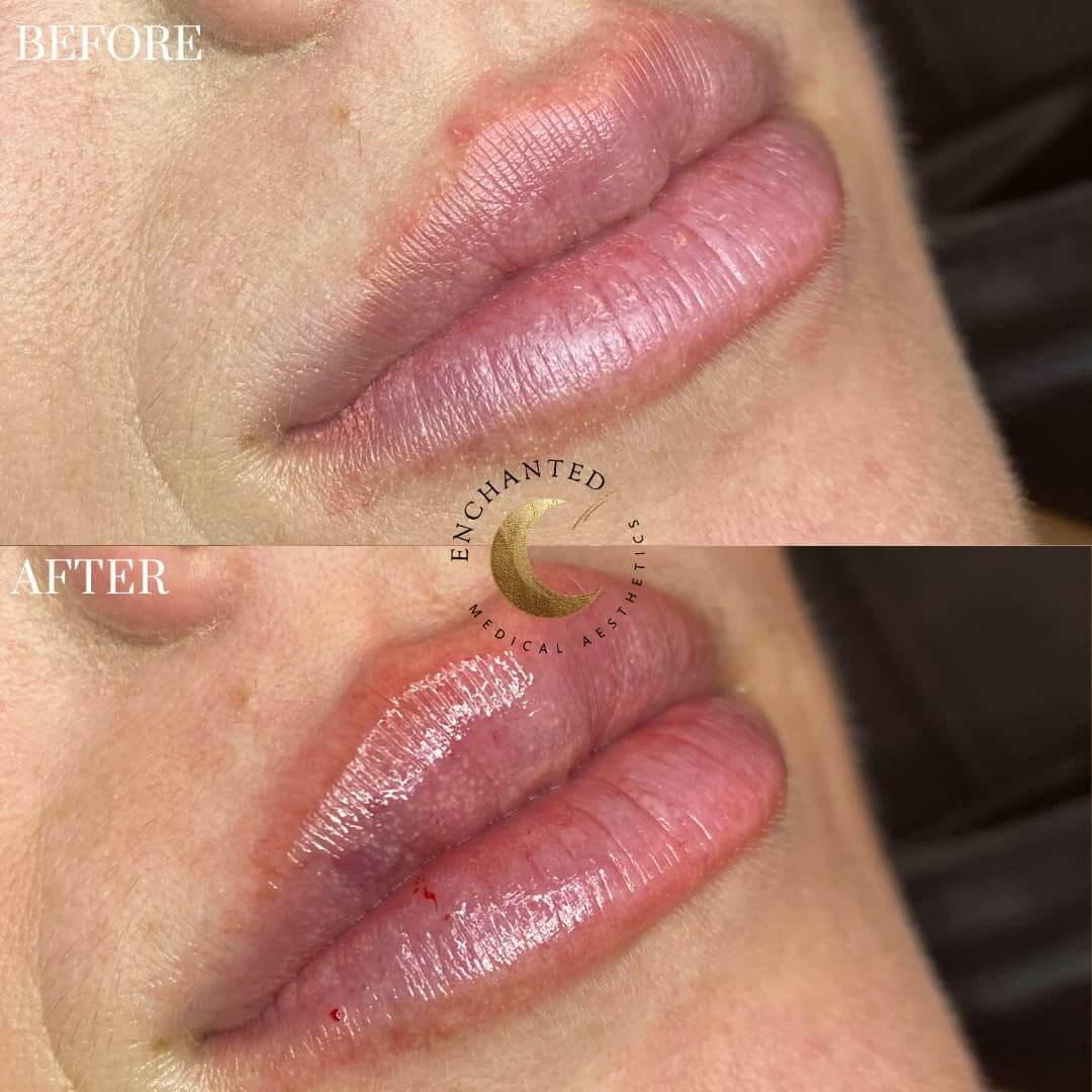 Lip Filler Injection Before and After By Enchanted Medical Aesthetics