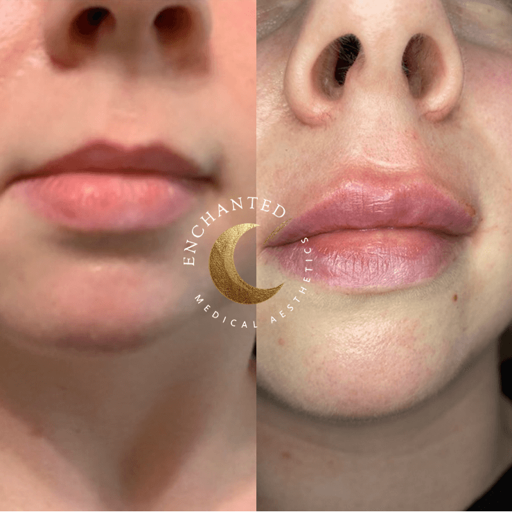 Lip Filler Before and After By Enchanted Medical Aesthetics