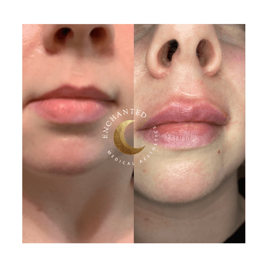 Lip Filler Before and After By Enchanted Medical Aesthetics