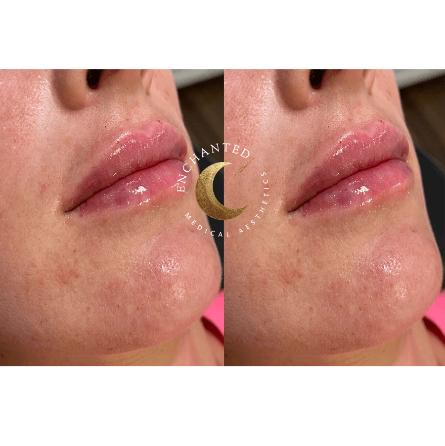 Lip Filler Before and After By Enchanted Medical Aesthetics