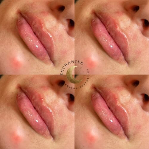 Lip Filler Service Before and After By Enchanted Medical Aesthetics