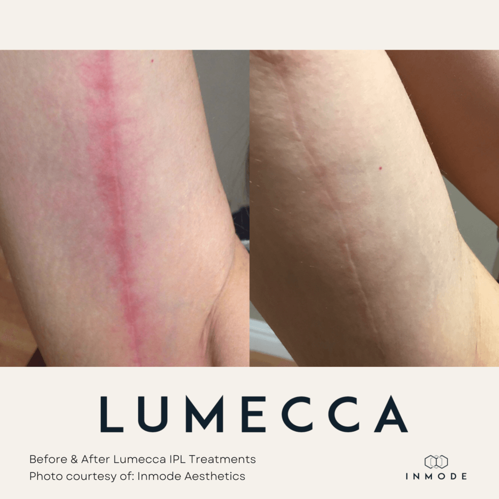 Lumecca IPL Treatment Before and After By Enchanted Medical Aesthetics