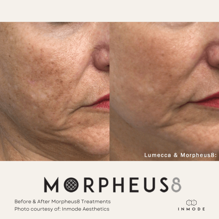 Morpheus8 Treatments Before and After By Enchanted Medical Aesthetics