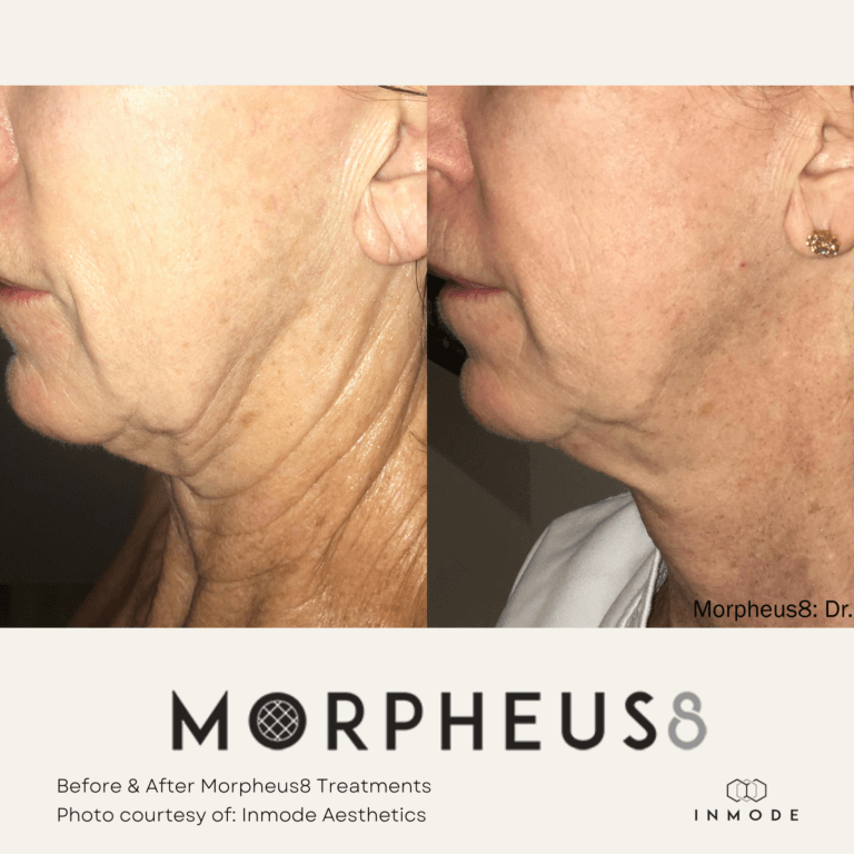 Morpheus8 Treatment Before and After By Enchanted Medical Aesthetics