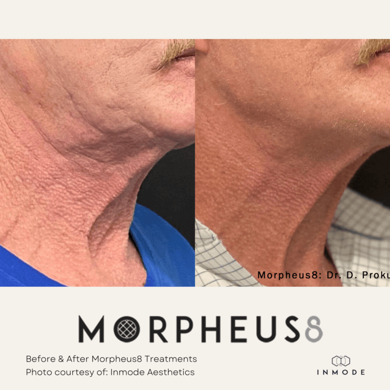 Morpheus8 Treatment Before and After By Enchanted Medical Aesthetics