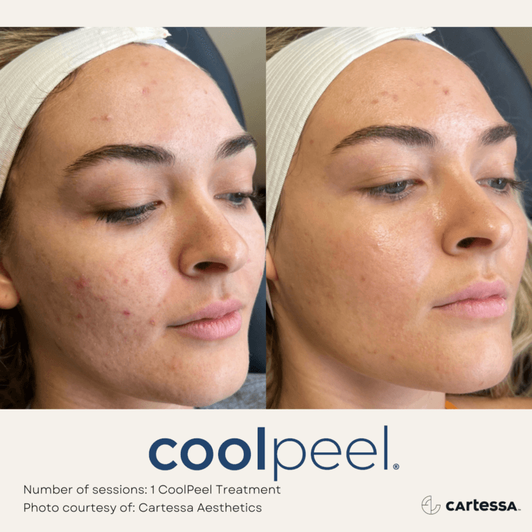 Coolpeel Treatment Before and After By Enchanted Medical Aesthetics
