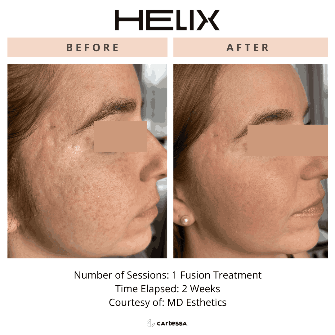 Helix Before and After By Enchanted Medical Aesthetics