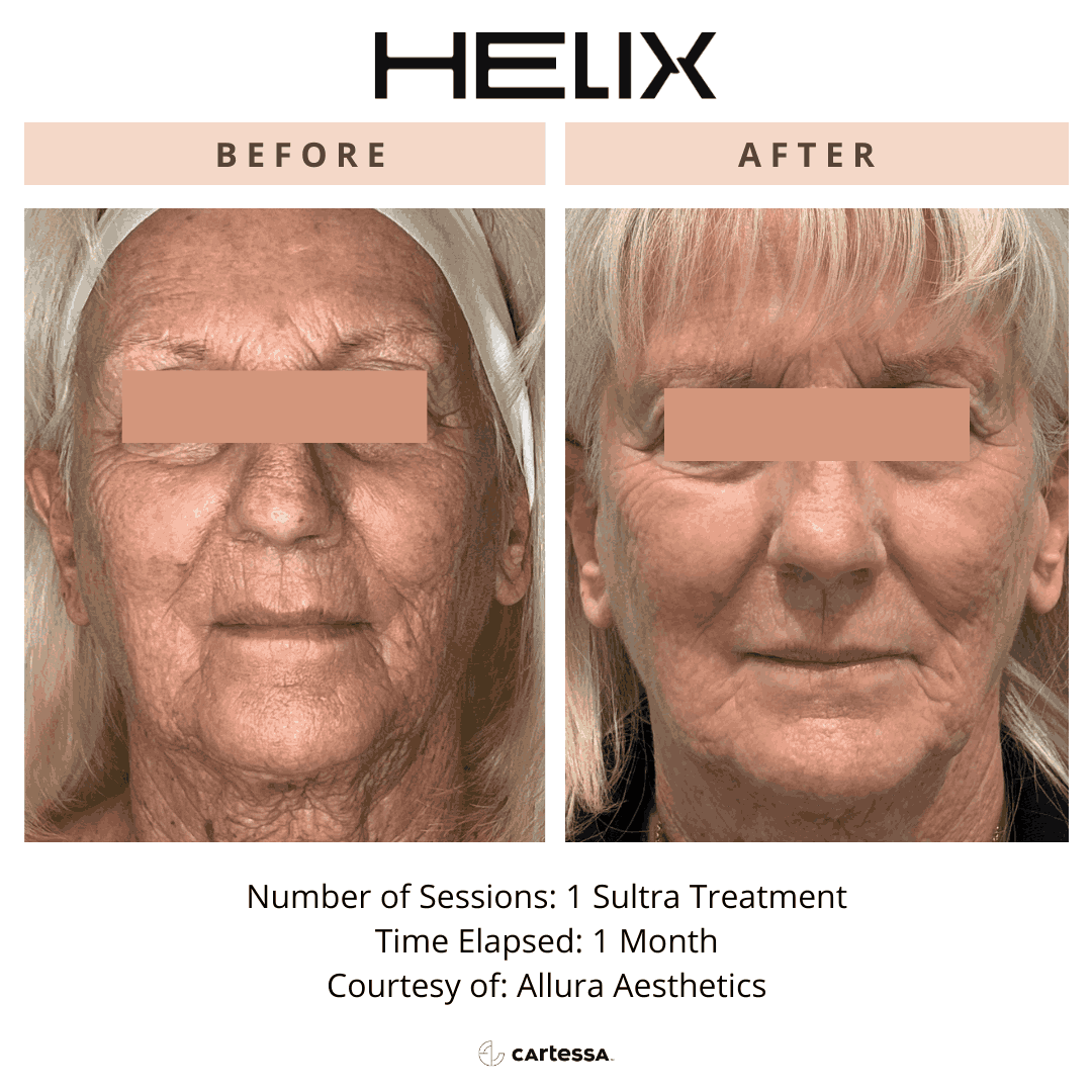 Helix Before and After By Enchanted Medical Aesthetics