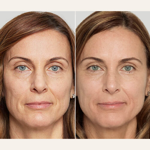 Sculptra Treatment Before and After Photos By Enchanted Medical Aesthetics