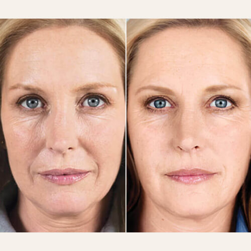 Sculptra Before and After Photos By Enchanted Medical Aesthetics